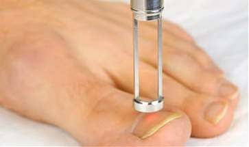 Lézeres Körömgomba eltávolítás