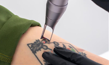  Lézeres Tetoválás eltávolítás